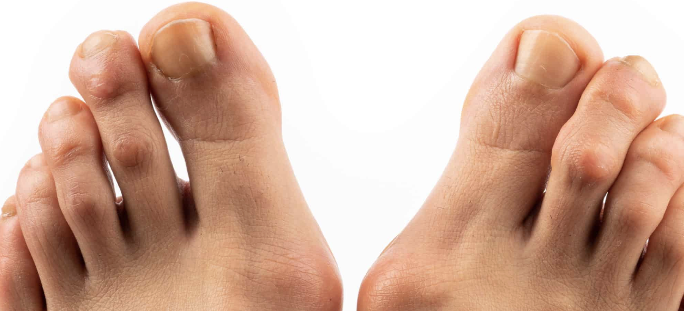 Teknik Stimulasi Mandiri untuk Mobilitas Tanpa Batas